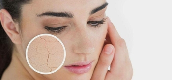 Dry skin and its care